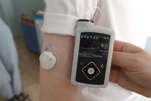 Детям с диабетом на Урале начали устанавливать помпы, имитирующие работу здоровой поджелудочной железы