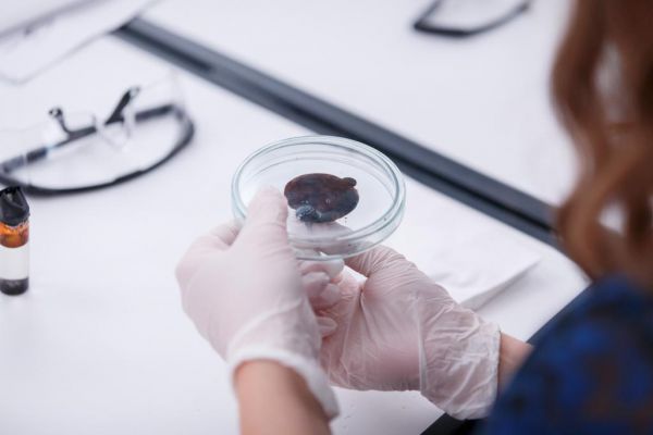 Роспотребнадзор назвал регионы, где больше всего зараженных вшами